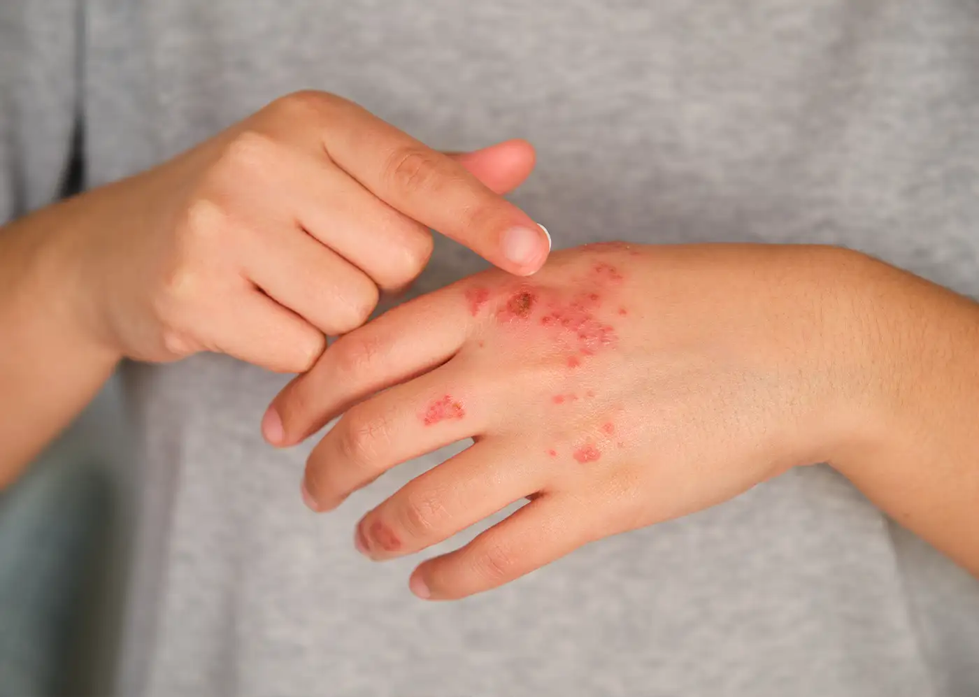 Ψωρίαση: Ένας Αόρατος Εχθρός του Σώματος και της Ψυχής