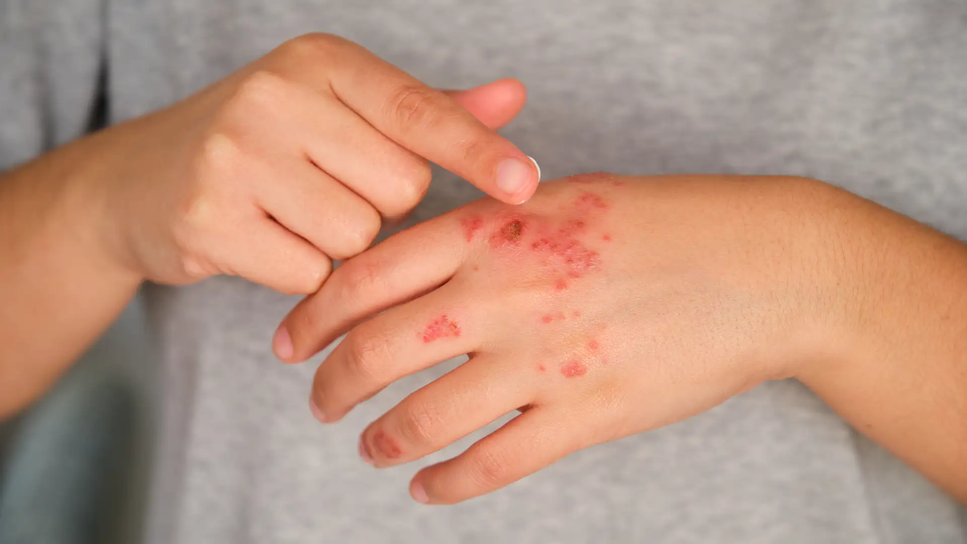 Ψωρίαση: Ένας Αόρατος Εχθρός του Σώματος και της Ψυχής